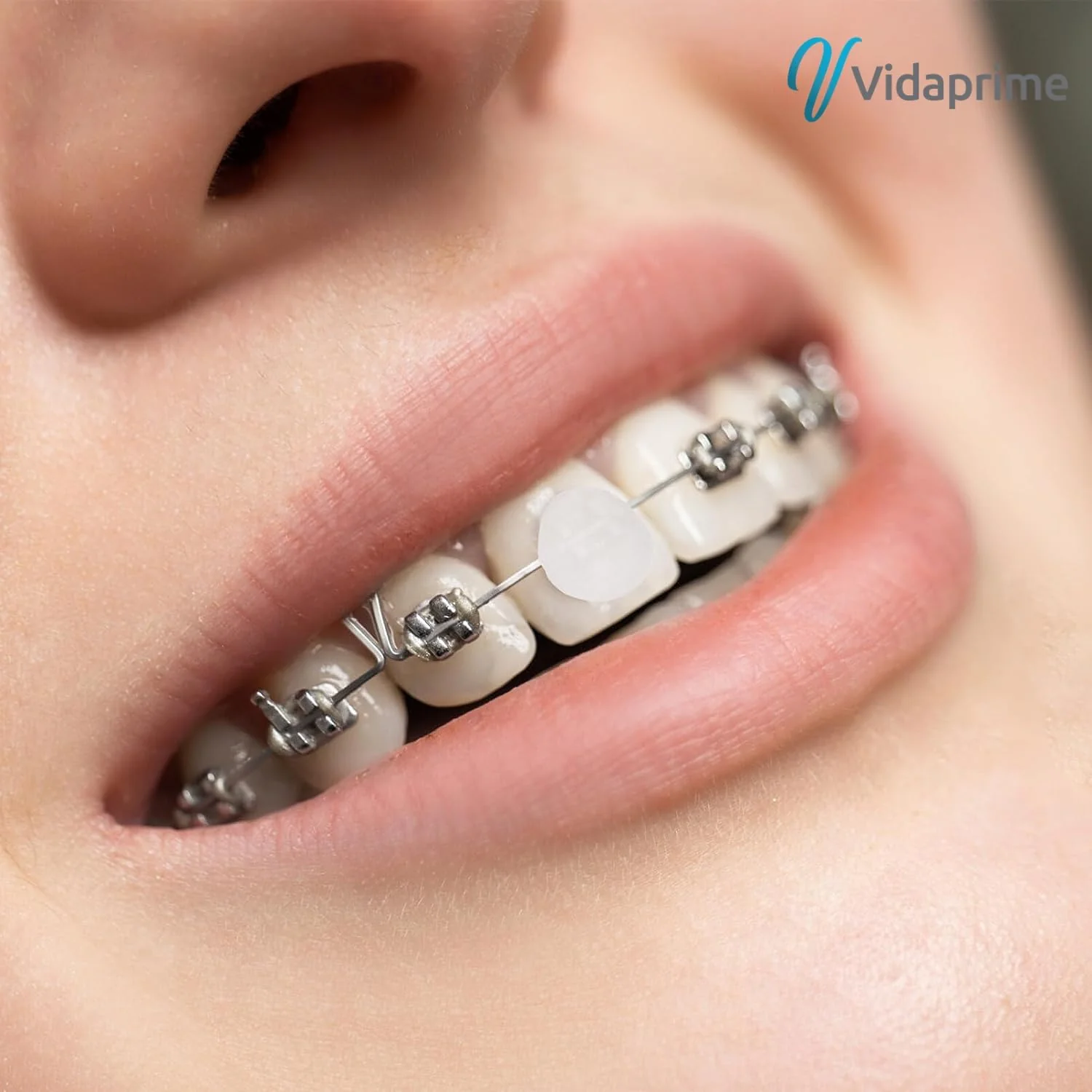 Cera Dental para Brackets Ortodoncia | Pack 10 Estuches - Image 5